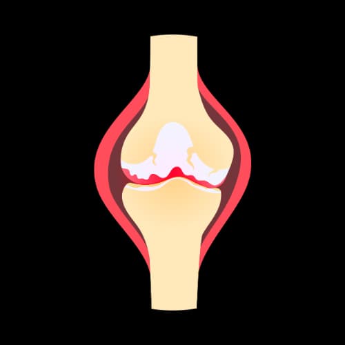 Illustratie bij Knieartrose (Gonarthrosis)