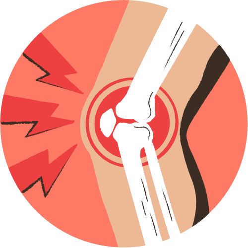Illustratie bij Retropatellaire chondropathie