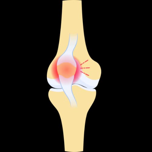 Illustratie bij Jumper’s knie (Patellapees tendinopathie)