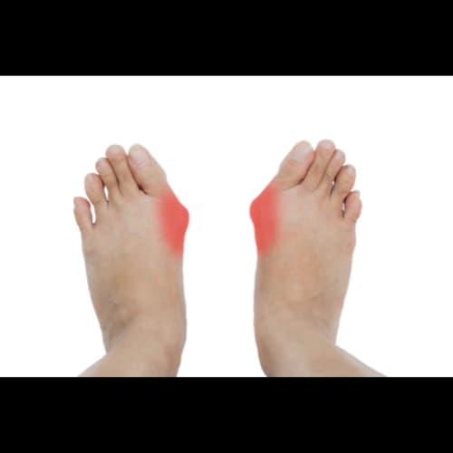 Illustratie bij Scheefstand van de grote teen (Hallux valgus) — afbeelding 1