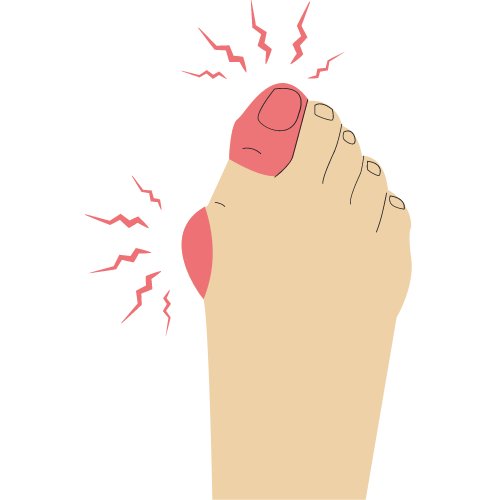 Illustratie bij Scheefstand van de grote teen (Hallux valgus) — afbeelding 2