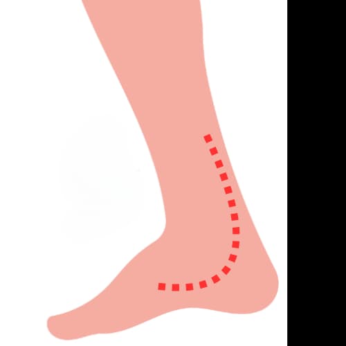 Illustratie bij Tendinopathie van de m. tibialis posterior